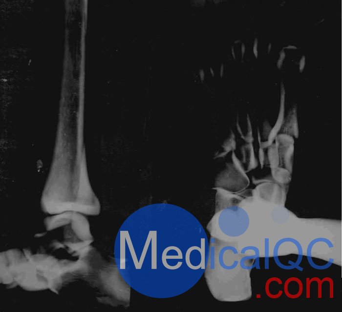 美國(guó)RSD RS-116腳模體，RS-116T透明腳模體