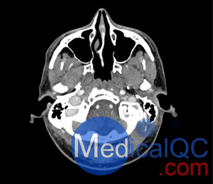 WEK50-04 CTA頭模，帶AVM CTA頭模，WEK50-04 CT血管造影頭模成像效果圖