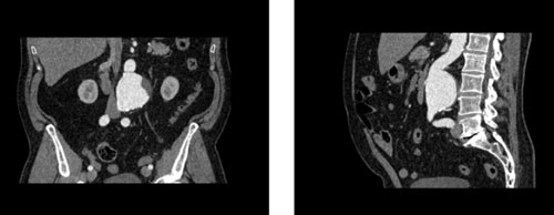 WEK53-05腹部模體，WEK53-05動脈瘤腹部模體，WEK53-05 CT血管造影模型成像