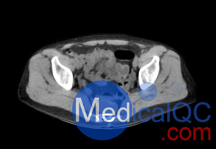 WEK55-02腹部骨盆模體，WEK55-02腹部骨盆模型成像效果圖