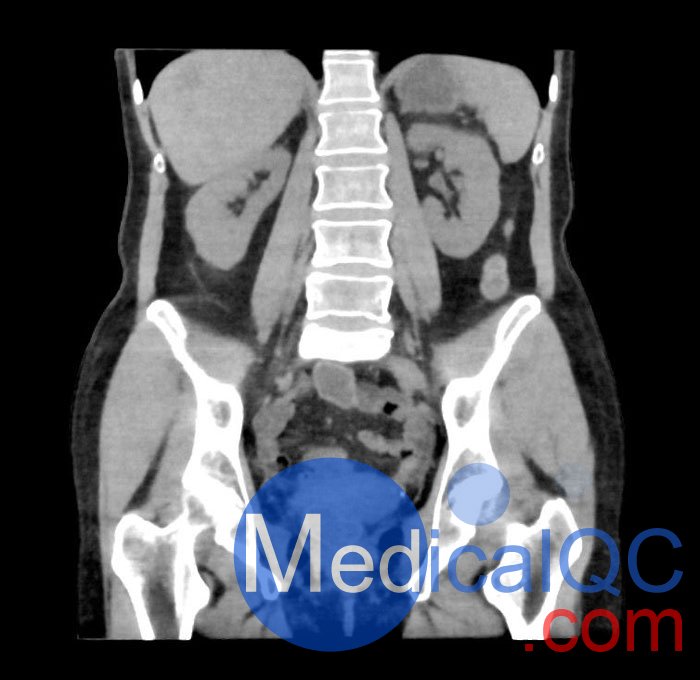 WEK55-02腹部骨盆模體，WEK55-02腹部骨盆模型成像效果圖